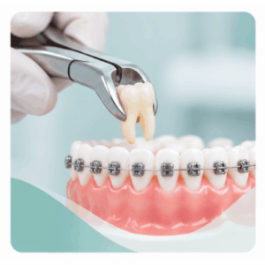 Space Creation & Tooth Alignment